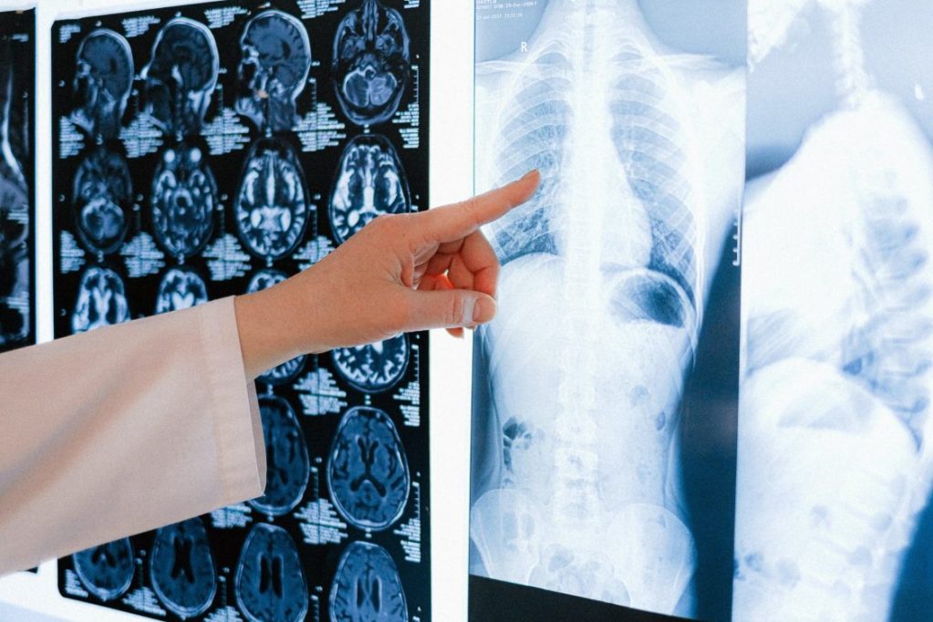 Cáncer de pulmón pandemia