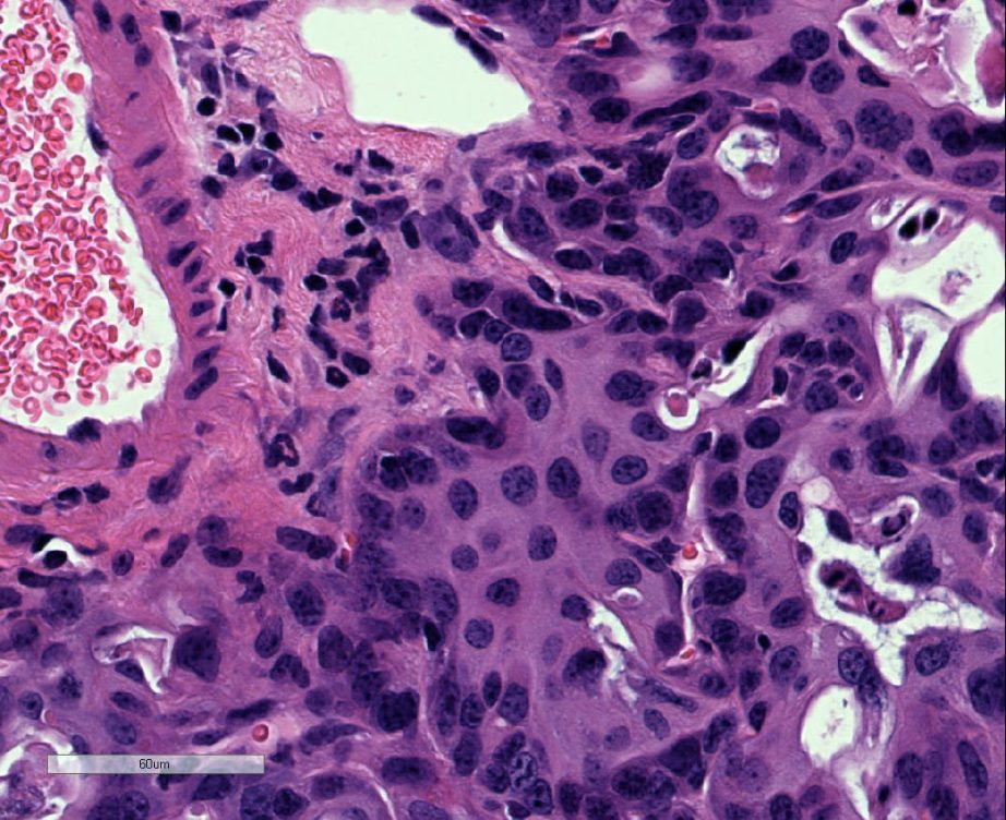 cáncer de pulmón