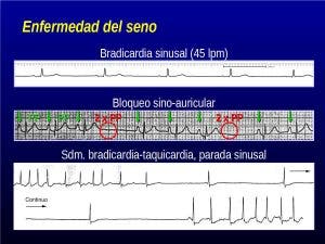Arritmias del corazón-Enfermedad del seno