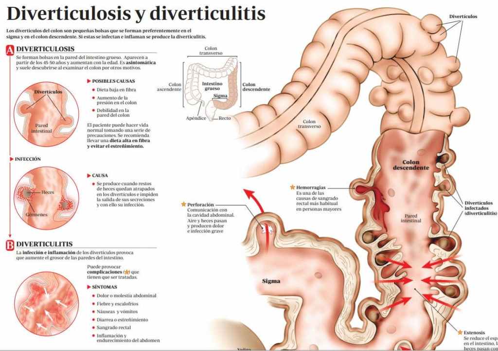 síntomas diverticulitis