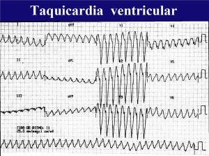 Taquicardias del corazón. taquicardia ventricular (TV)