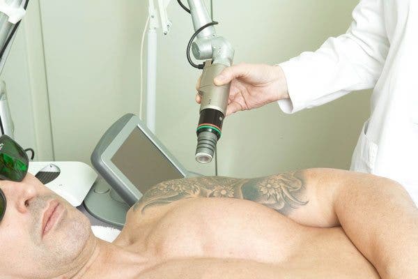 eliminación de tatuajes