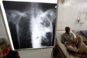 tuberculosis resistente tratamiento