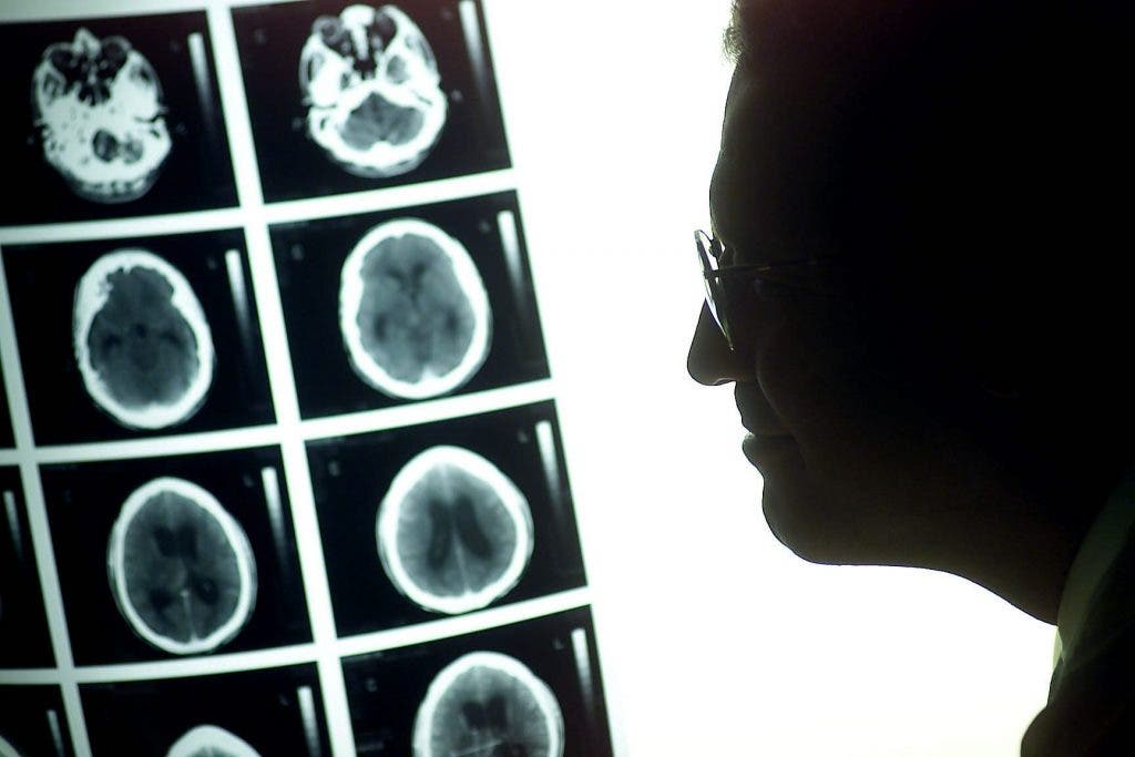 tumores cerebrales