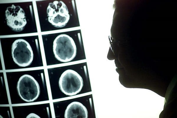 tumor cerebral 
