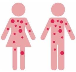 Urticaria