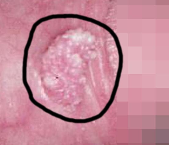virus papiloma en zona del prepucio-efe