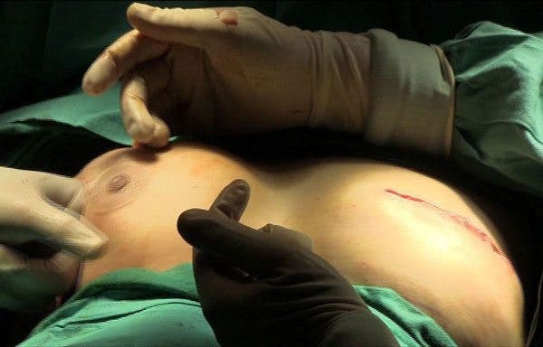 mastectomía preventiva