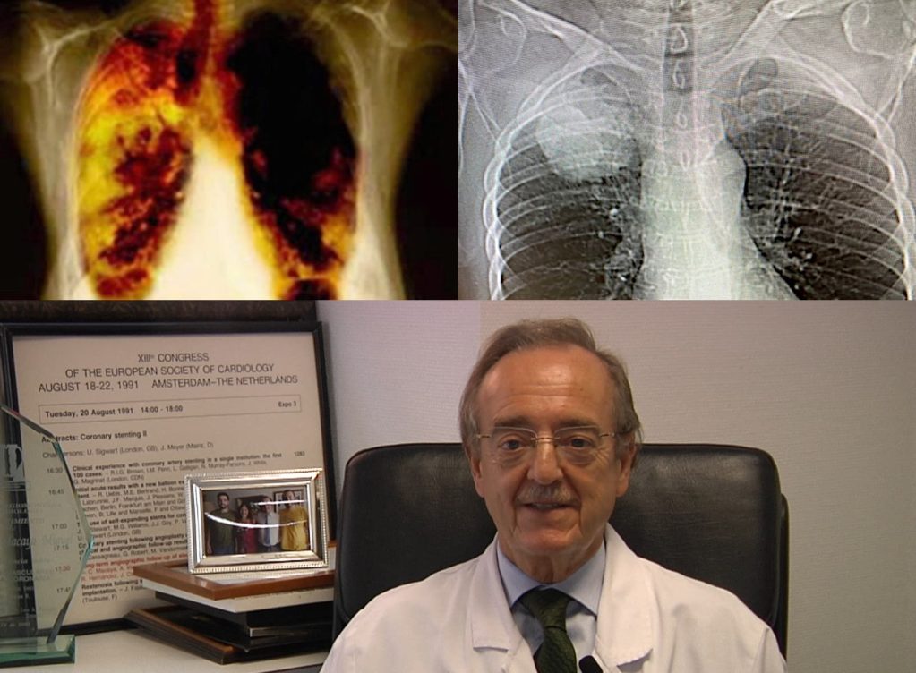 Cáncer células grandes o adenocarcinoma de pulmón-efe