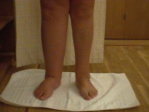 linfedema, brazos, mano, mujer, enfermedad, Día Mundial del Linfedema, tratamiento, diagnóstico, pacientes, oncológicos