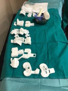 rodilla, operación, cirugía, quirógrafo, prótesis, personalizada