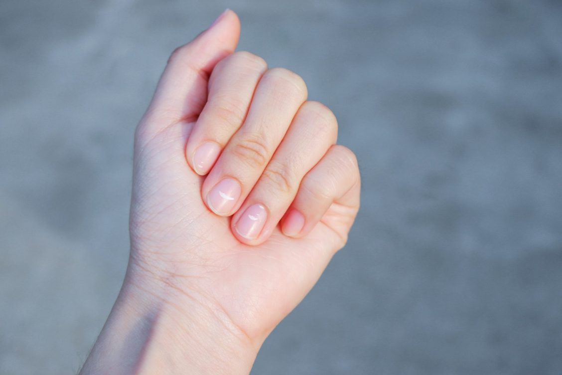 Uñas con manchas blancas