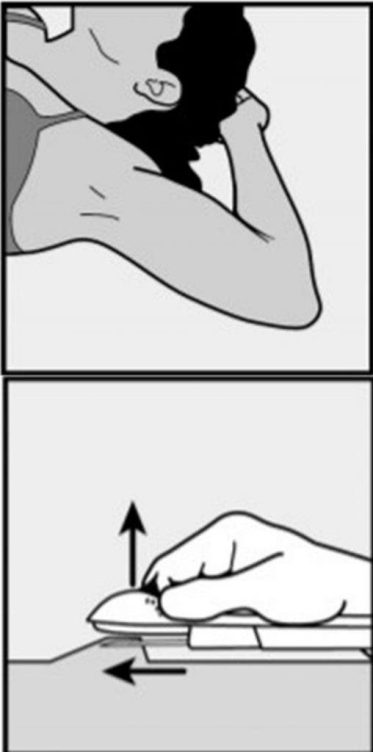 implante hormonal proceso de inserción