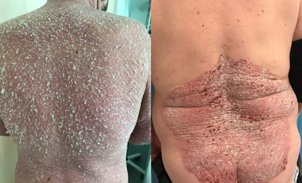 Psoriasis