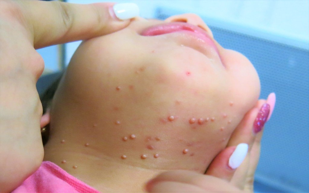Pápulas generadas por la infección de molusco contagioso en la zona inferior de la cabeza, submentón, de un bebé.