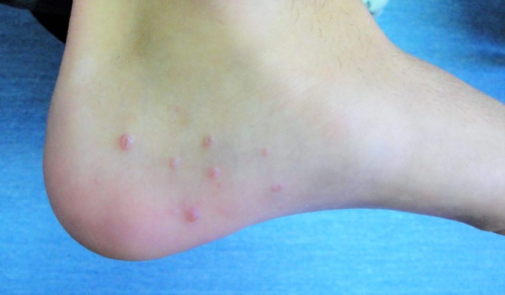 Pápulas generadas por la infección de molusco contagioso en el pie de un adolescente.
