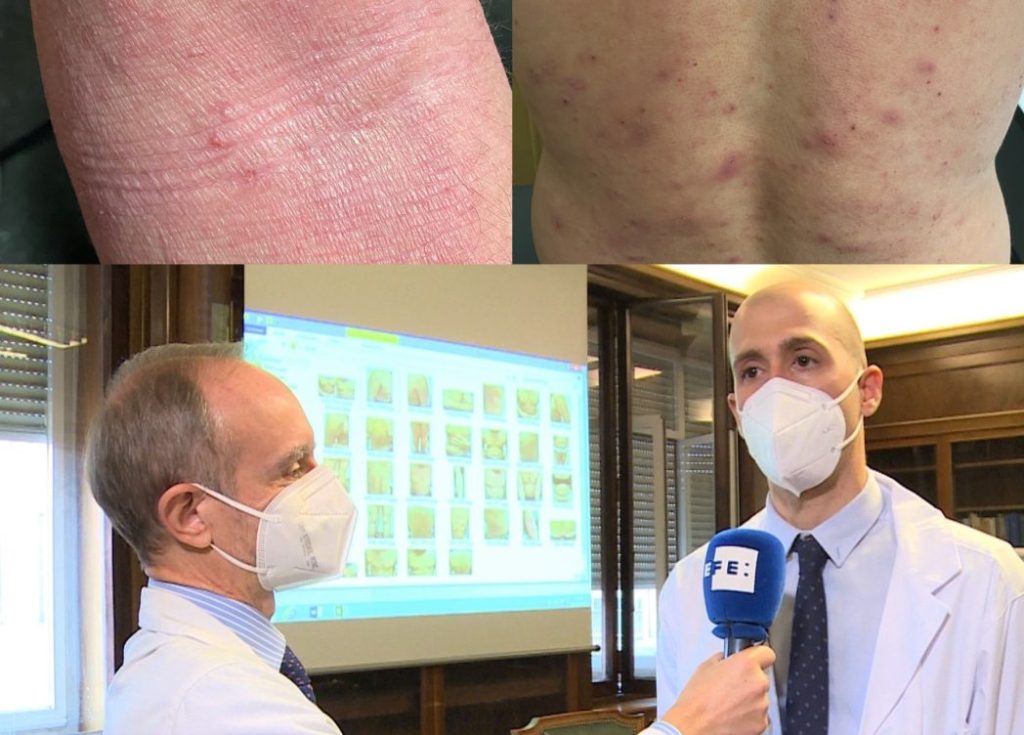 Dermatitis atópica