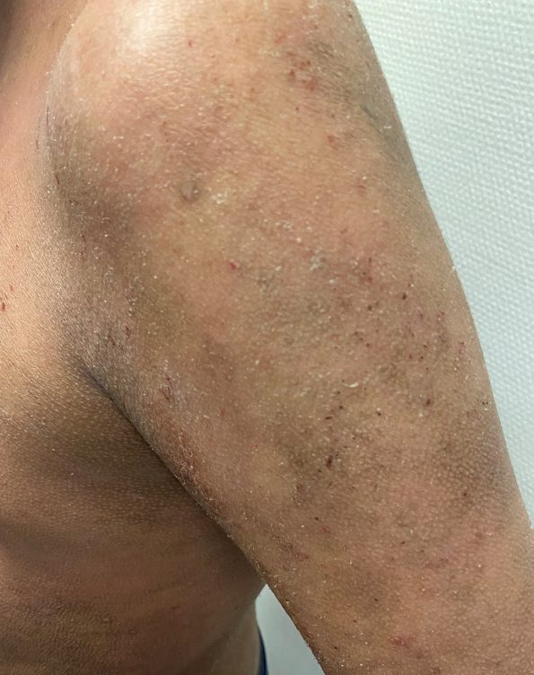 Dermatitis atópica