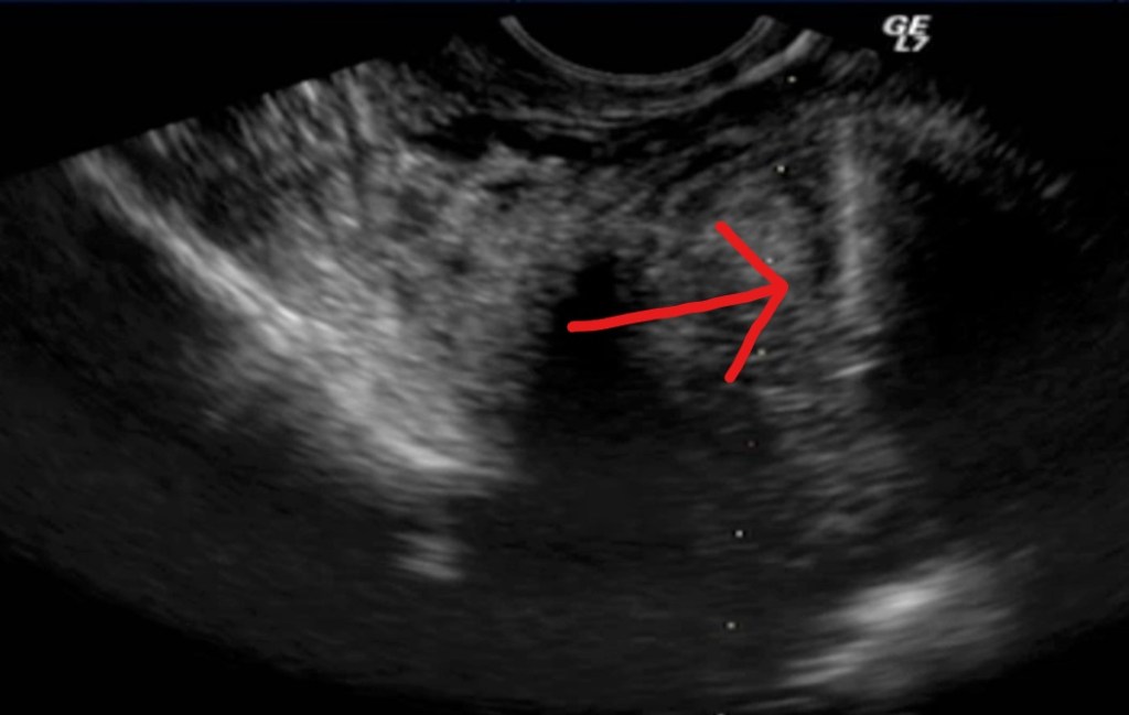 Biopsia de miomas uterinos