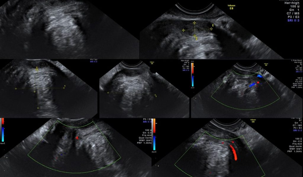 Miomas uterinos. Ablación por radiofrecuencia.