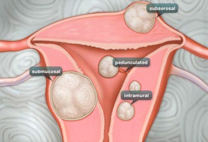 Tipología de miomas uterinos: submucosos, intramurales y subserosos.