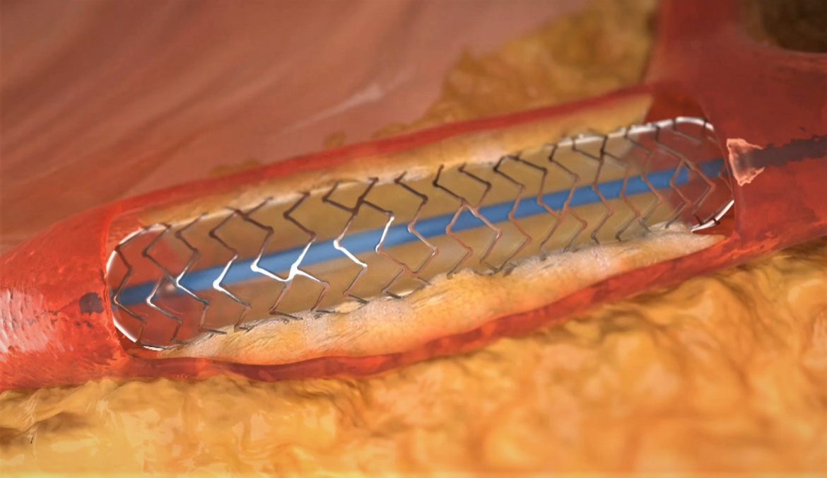 Angioplastia en el corazón posterior al uso del rotablator