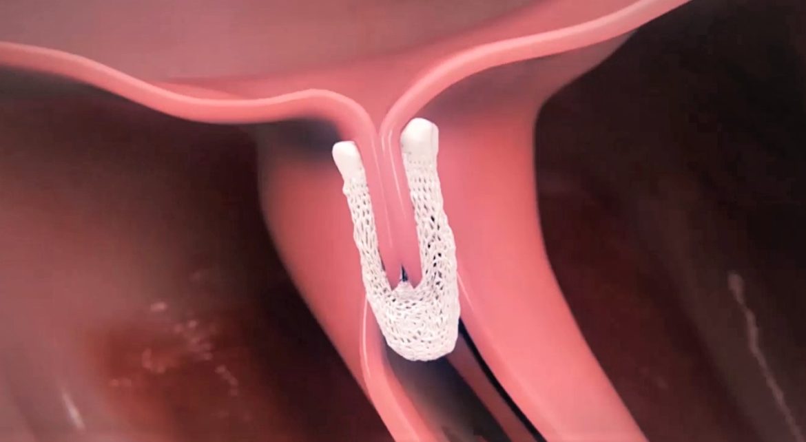 Mitraclip en la válvula mitral dañada