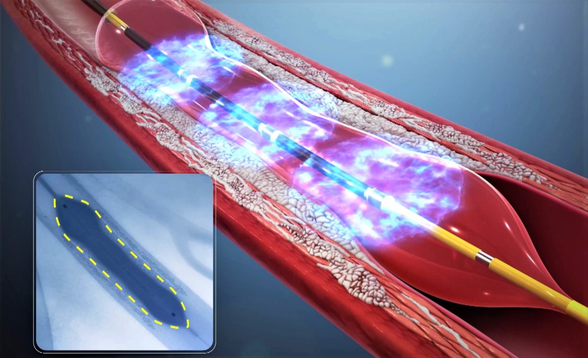Acción del dispositivo shockwave en una arteria del corazón para romper la placa de ateroma