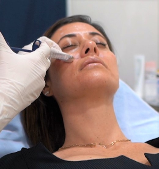 Belleza facial: surcos nasogenianos con ácido hialurónico.
