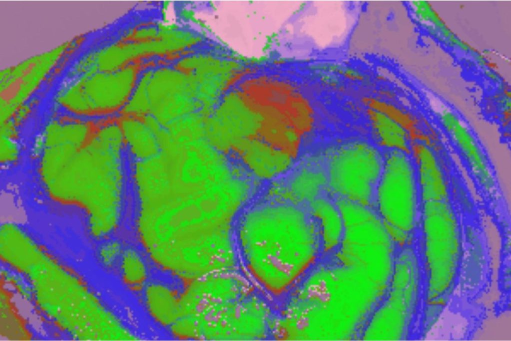tumor cerebral proyecto NEMESIS