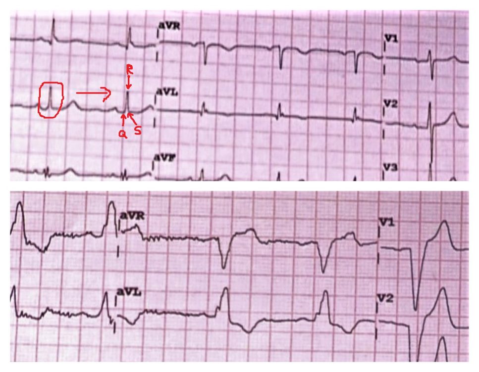 resincronización cardíaca: comparativa electrocardiograma normal y con bloqueo de rama izquierda