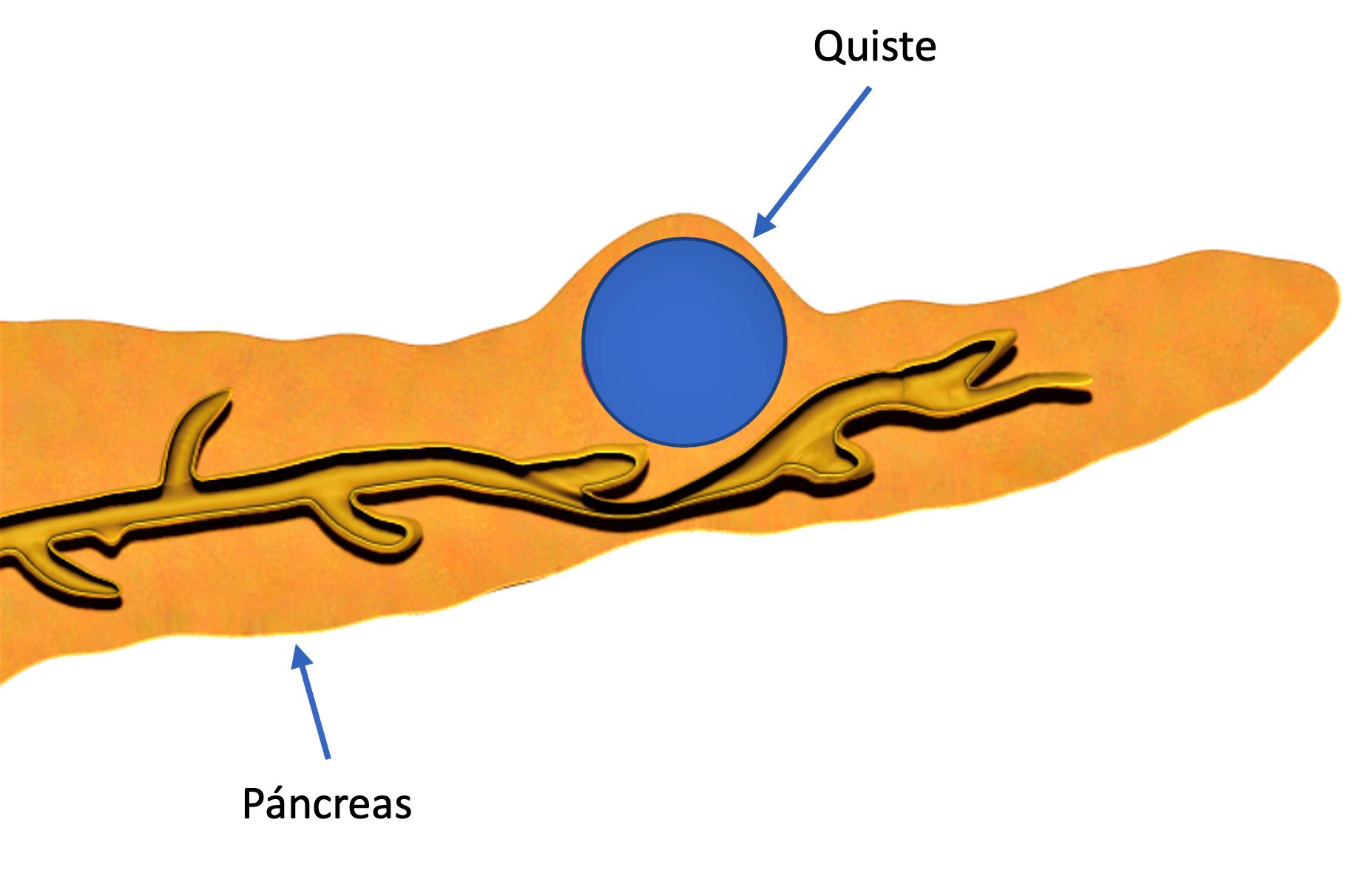 quiste pancreático.