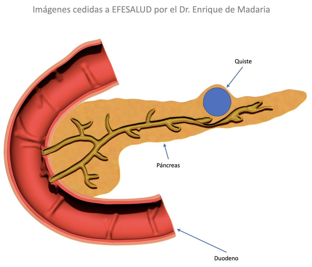 páncreas: quiste pancreático.