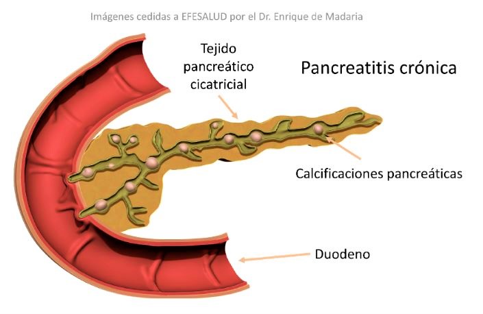 páncreas: pancreatitis crónica
