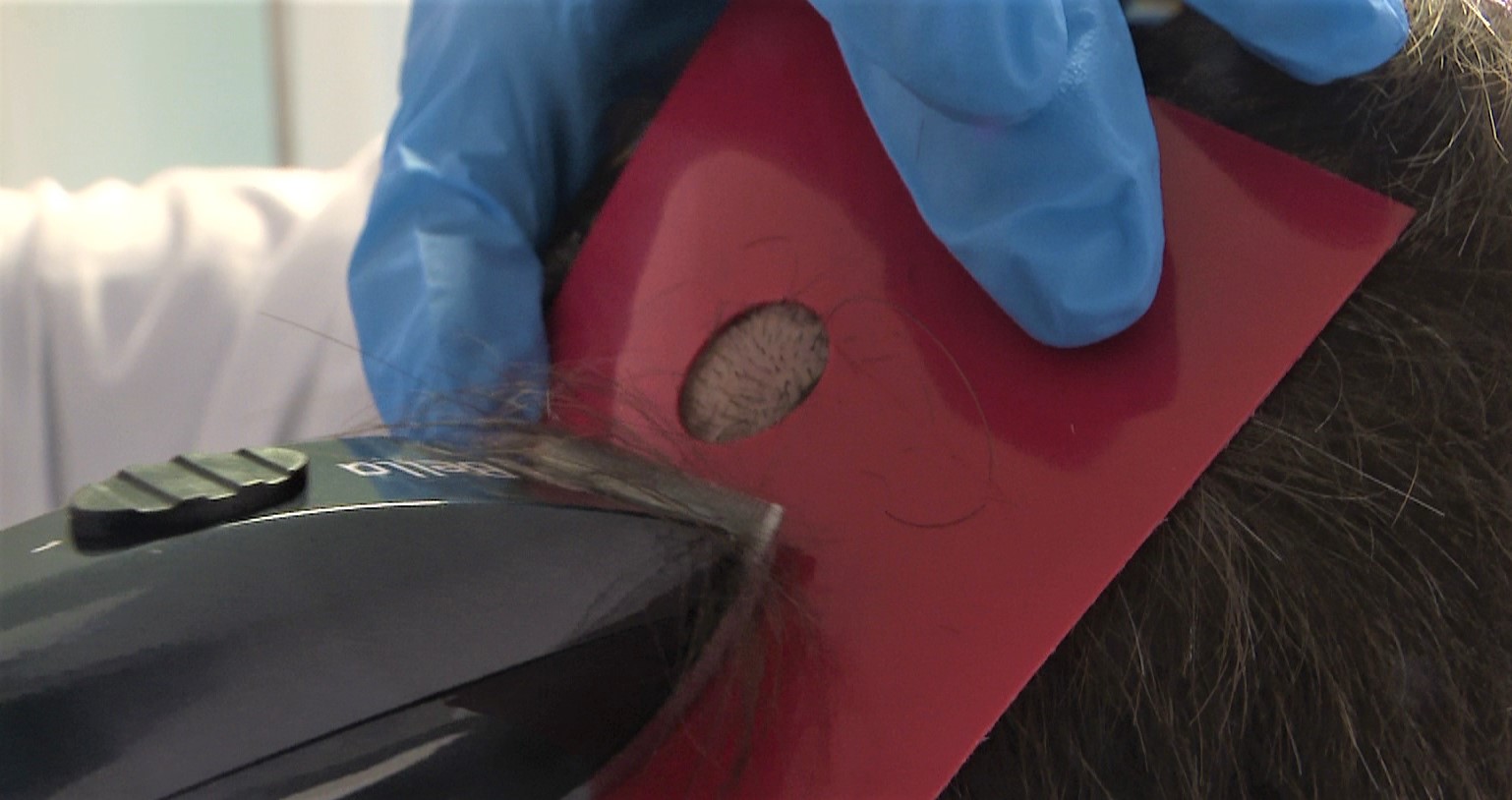 Zona rasurada para análisis tricoscópico de la alopecia.