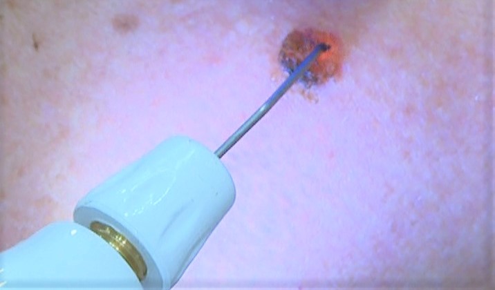 Aplicaciones del láser de plasma PlexR
