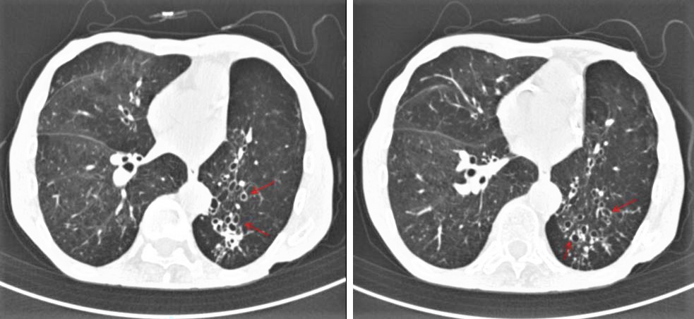 Diálogos de salud respiratoria: bronquiectasias