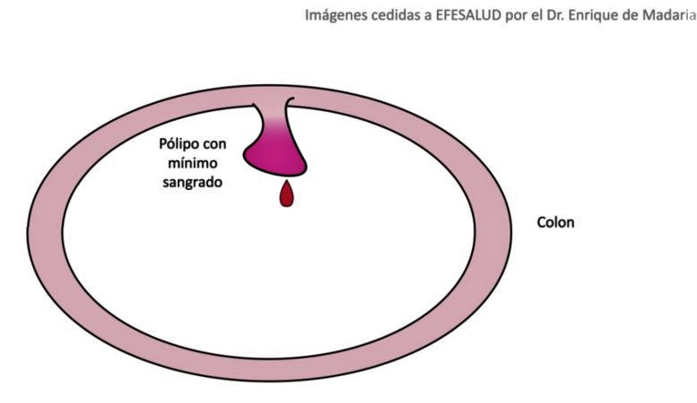 Pólipos malignos y benignos en el colon o intestino grueso.