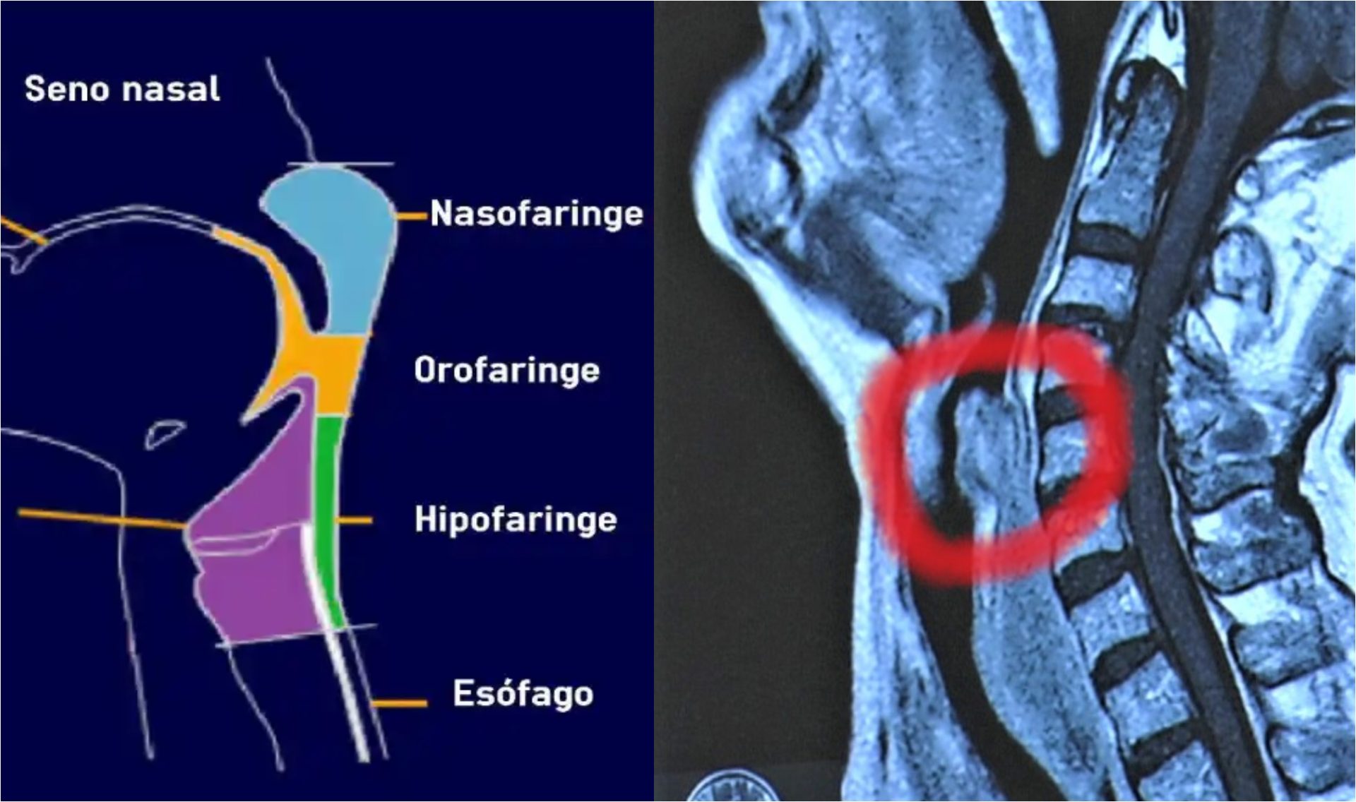 Cáncer en la garganta por papilomavirus VPH