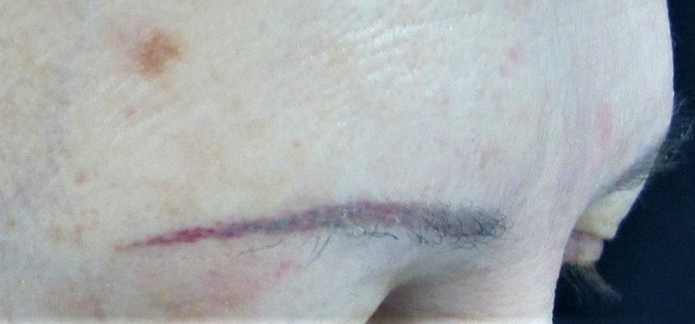 Alopecia frontal fibrosante