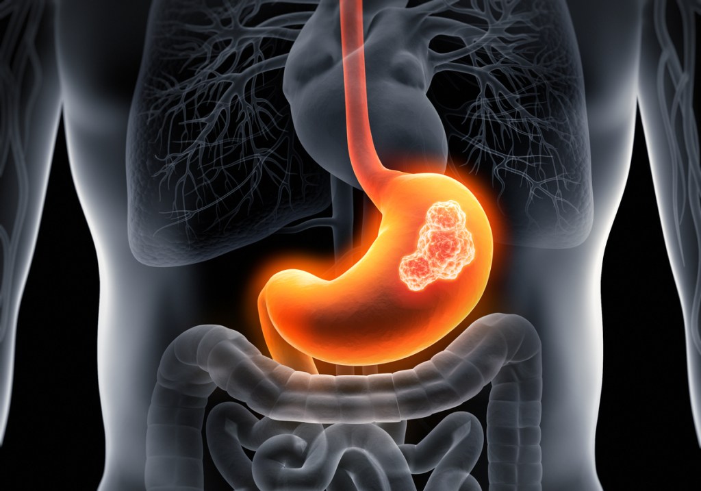 cáncer gástrico Quirónsalud