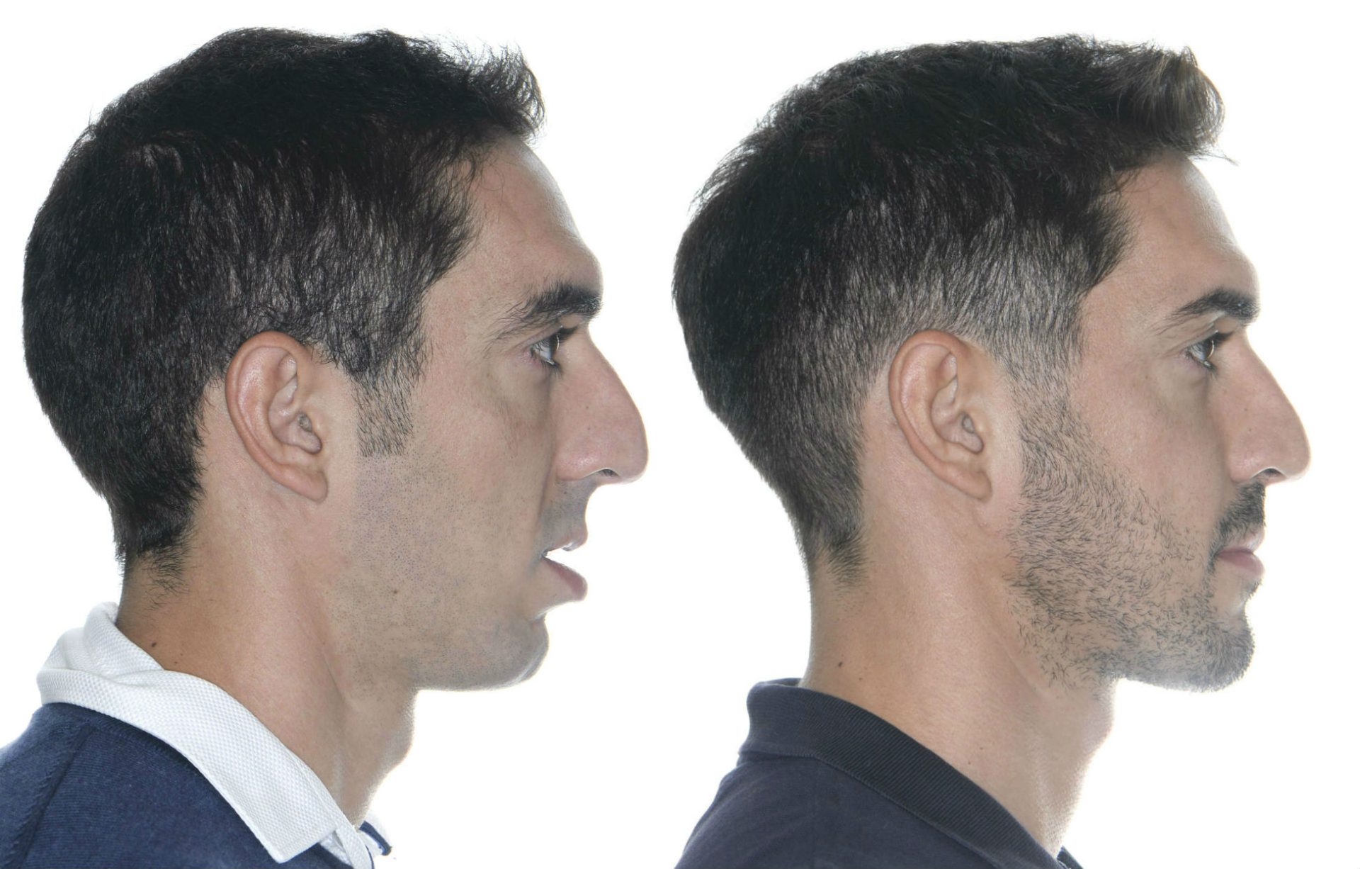 cirugía ortofacial
