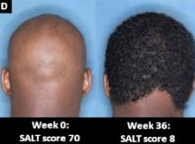 Alopecia areata: tratamientos innovadores