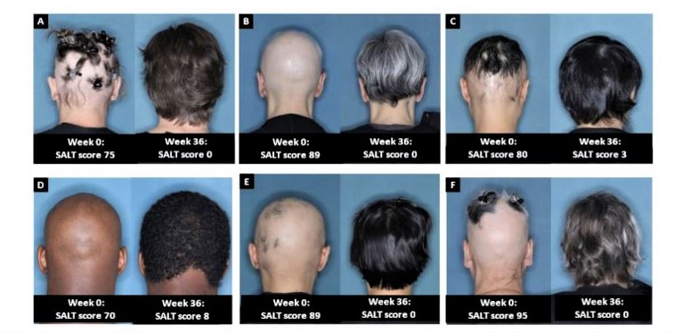 Alopecia areata: tratamientos innovadores