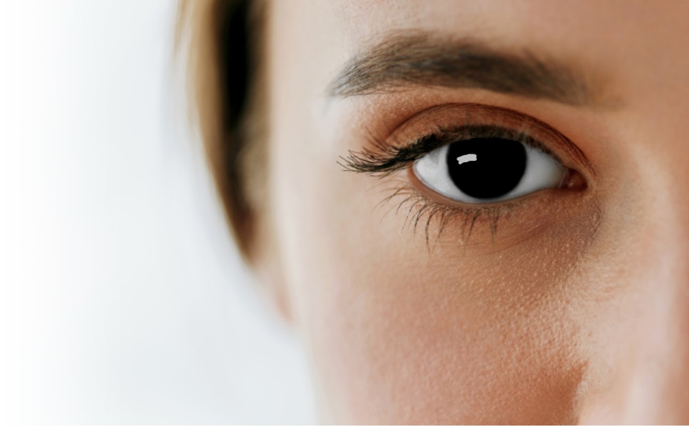 Aniridia. Ojo sin iris.