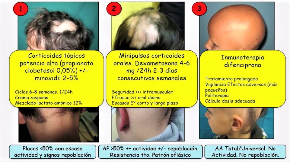 Alopecia areata: tratamientos innovadores
