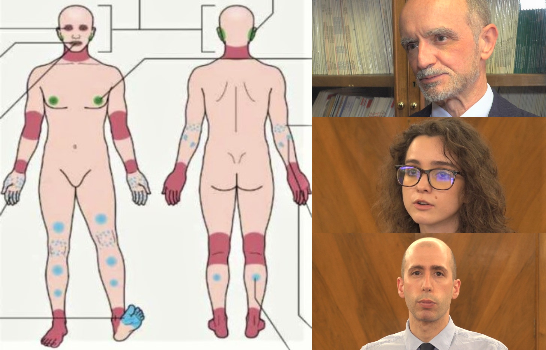 Dermatitis atópica, tratamientos innovadores.