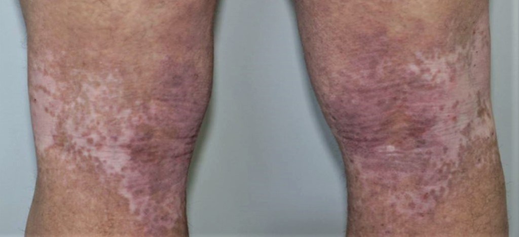 Dermatitis atópica, tratamientos innovadores.