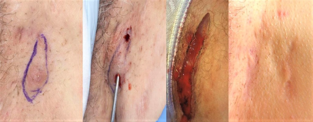 Tratamientos de vanguardia contra la hidradenitis supurativa