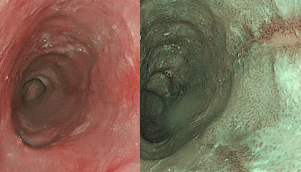 Imágenes de zona del tubo digestivo sin y con cromoendoscopia obtenidas a través de endoscopio.